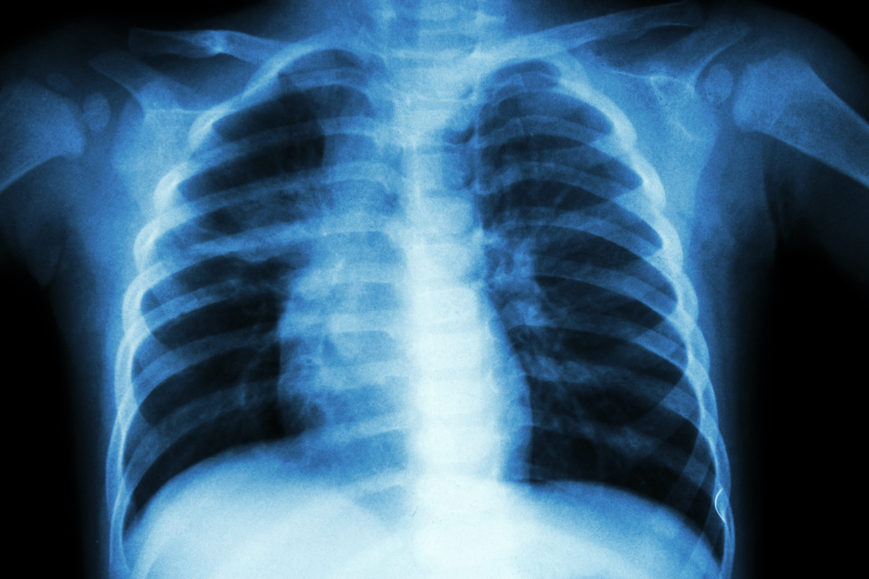 decisaotuberculose.jpg