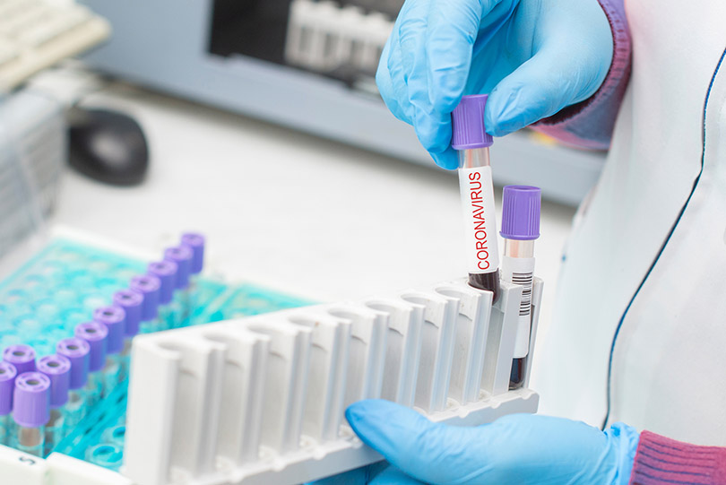 Pra Cego Ver: foto de Tutye/iStock Banco de Imagens mostra mãos de profissional da Saúde segurando tubos de ensaio, com amostras de sangue, para testes de coronavírus. Ao fundo, máquina de análises laboratoriais.